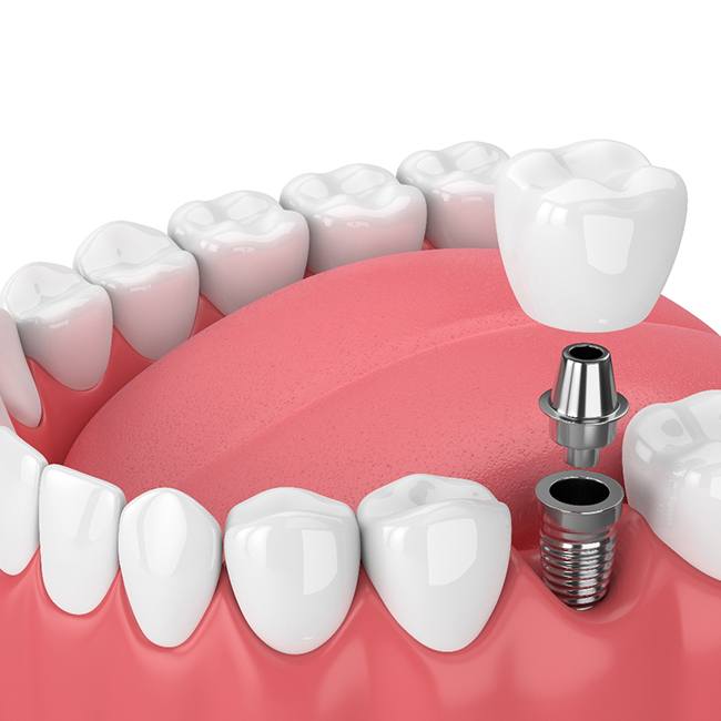 Ilustración de un solo implante dental que se coloca en la mandíbula